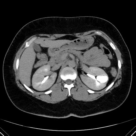 Calyceal diverticulum | Radiology Case | Radiopaedia.org