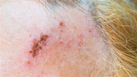 First Blush: Early Symptoms of Shingles