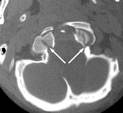 Radiologic and Clinical Spectrum of Occipital Condyle Fractures Retrospective Review of 107 ...