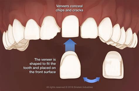 Veneers Southlake, TX - Colleyville, TX - Keller, TX - Porcelain Veneers - Fuqua Advanced Dental