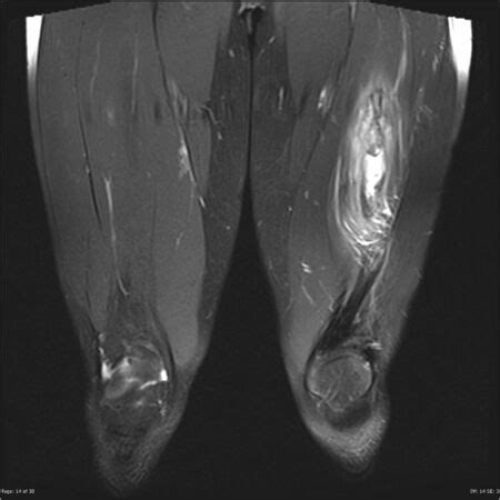 Myositis Ossificans - Physiopedia