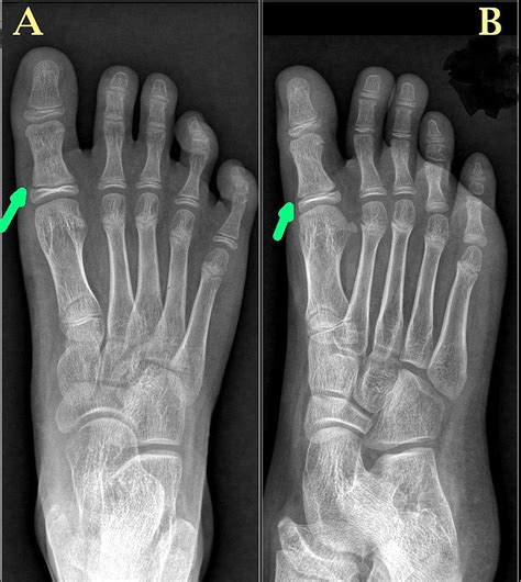 Cureus | Type 2 Salter-Harris Physeal Injury of the Proximal Phalanx of ...