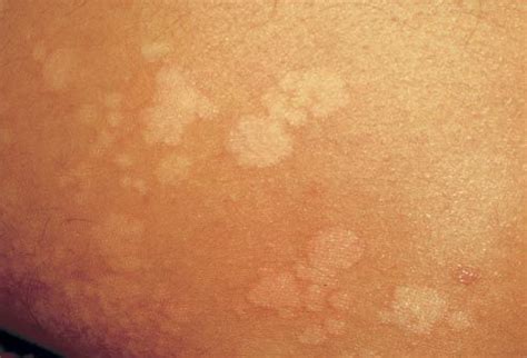 What Are the White Spots Found on Your Skin? – Dualight – High Quality Light Therapy Systems