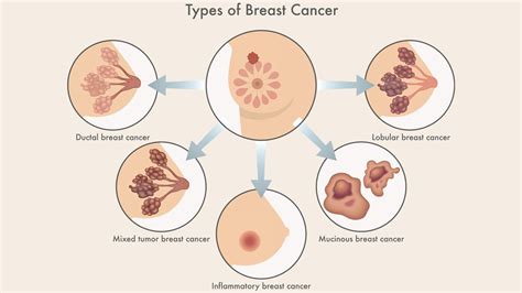 Understanding Different Types of Breast Cancer