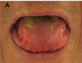 Macroglossia | Treatment & Management | Point of Care