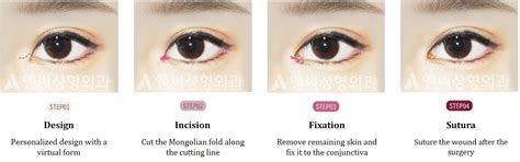 Epicanthic Fold Before After