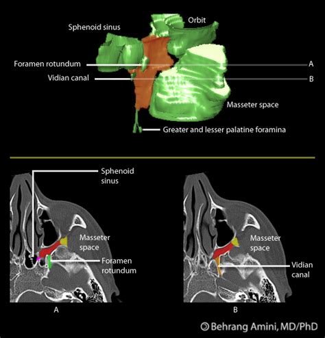 Pterygopalatine fossa | Image | Radiopaedia.org