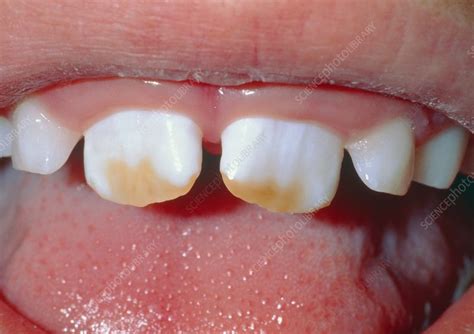 Brown staining of child's teeth due to fluorosis. - Stock Image - M782/0081 - Science Photo Library