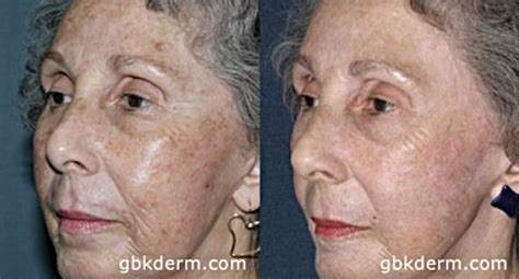 Age Spots: Causes, Risk Factors, and Treatment Options: Essence Medispa: Cosmetic Dermatology