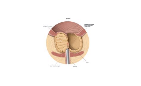 Laser Prostatectomy - Prostate Laser Surgery - Ashvin Clinic | Dr. K. Ramesh | Centre for ...