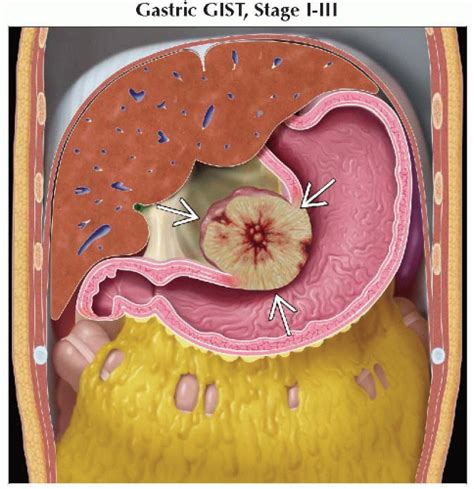 Gastrointestinal Stromal Tumor (GIST) | Radiology Key