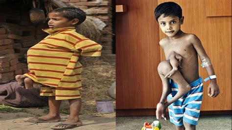 A Boy With Four Arms & Four Legs | Deepak Paswan | The 8 Limbed Boy ...