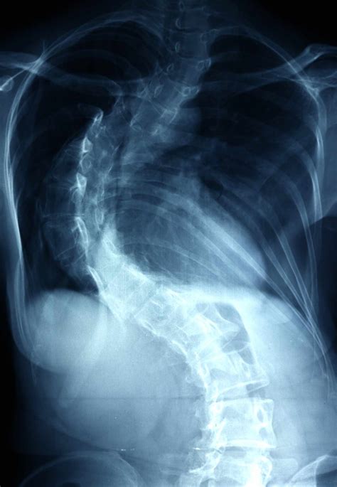 Levoscoliosis vs. Dextroscoliosis: Difference & Diagnosis