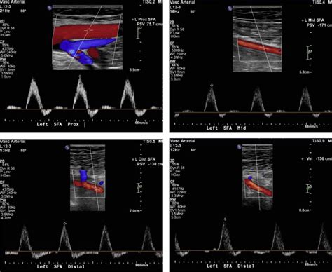 Venous Doppler Lower Limb Treatment