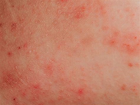 The Difference Between Rosacea, Psoriasis and Eczema | Reader's Digest