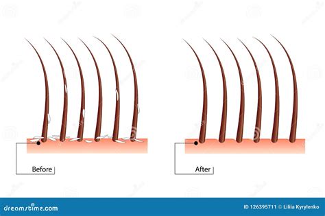 The Problem of Dandruff Hair. before and after the Procedure Stock Illustration - Illustration ...