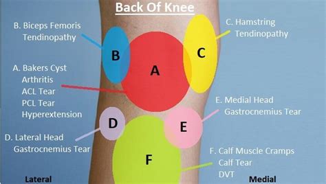 What Causes Posterior Knee Pain - Margaret Greene Kapsels