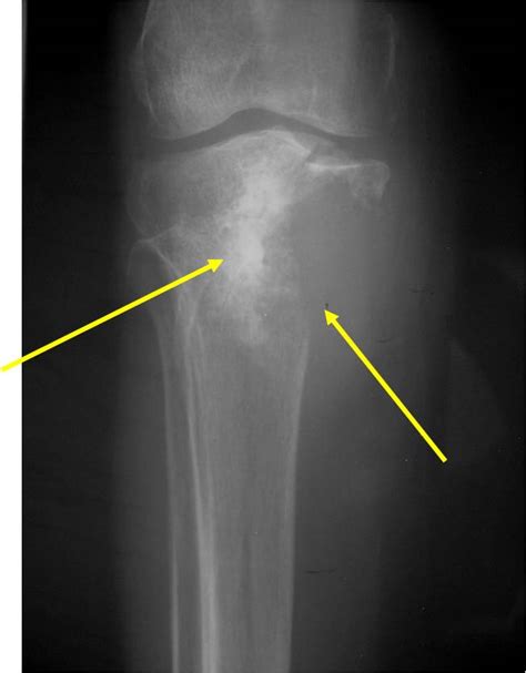 Dedifferentiated Chondrosarcoma : Bone Tumor Cancer : Tumors of the bone