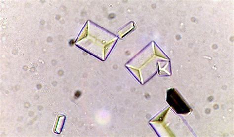 Types of Crystals Found In Human Urine and Their Clinical Significance ...