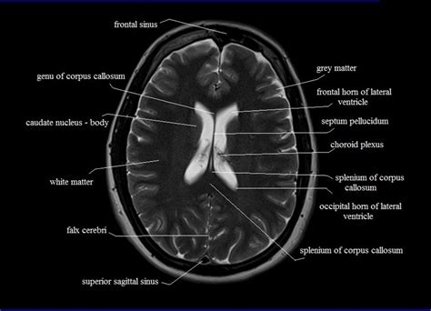 Ct Scan Brain Anatomy : Anatomy Of Head Ct Scan Normal The Brain On Ct And Mri ... / Frontal ...