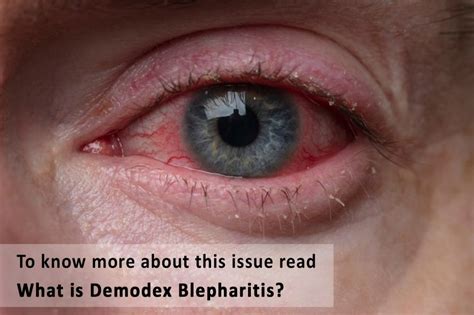 What is Demodex Blepharitis - Ungex | Demodex treatment