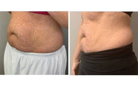 Laser Lipo | Before & After | LightRx MedSpa