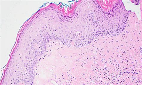 Lichen sclerosus of the vulva - MyPathologyReport.ca