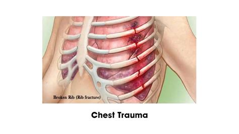 Chest Trauma Treatment In Delhi | Dr. Arvind Kumar