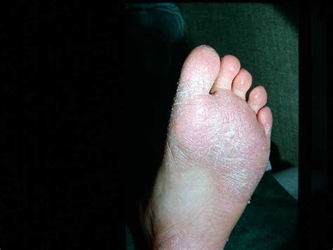 Juvenile Plantar Dermatosis (atopic winter feet, forefoot dermatosis ...