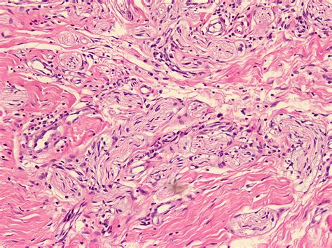 Mortons Neuroma Histology