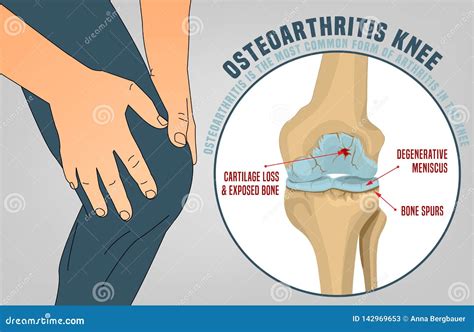 Osteoarthritis Of The Knee In Four Stages - High Degree Of Detail - 3D ...