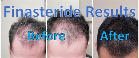 Finasteride Before and After Pictures & Reddit Stories