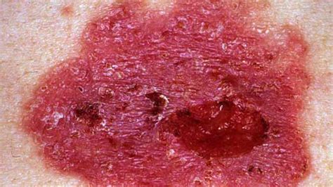 Basal Cell Carcinoma Skin Cancer Symptoms