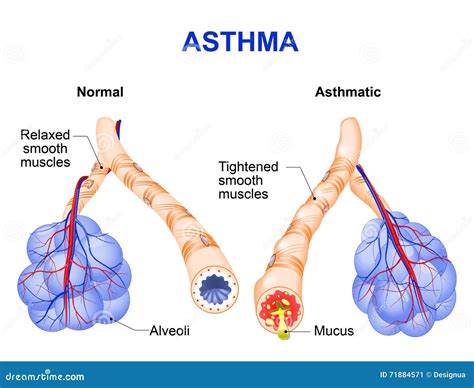 Asthma - Chronic Inflammatory Disease - Anatomy Royalty-Free Stock Photography | CartoonDealer ...