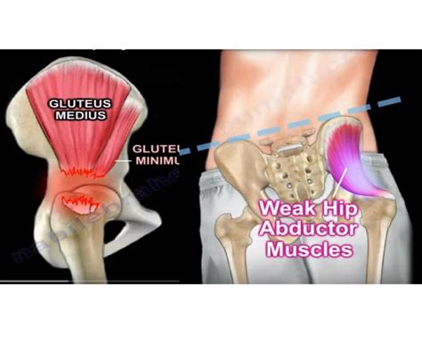 Gluteus Medius Tendon Tears — OrthopaedicPrinciples.com