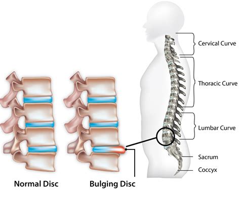 Herniated Disc (Slipped Disc) - Causes and Symptoms | SportNova UK