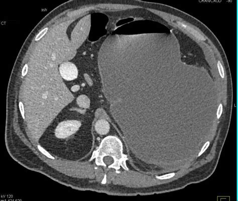 Gastric Volvulus - Stomach Case Studies - CTisus CT Scanning