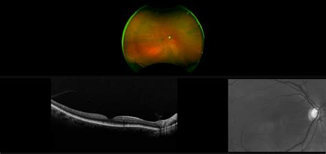 California - Glaucoma Suspect, RG, AF, Stereo