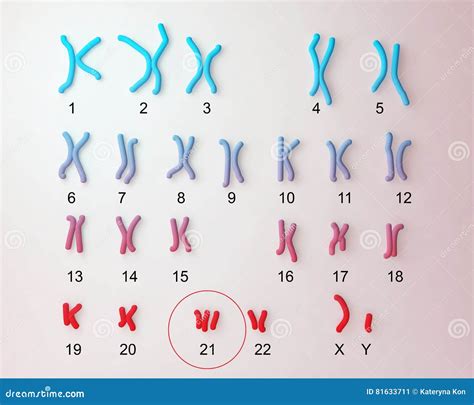 Down-syndrome karyotype stock illustration. Illustration of medicine - 81633711