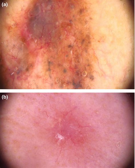 Dermoscopy of basal cell carcinoma - Wozniak‐Rito - 2018 - Clinical and ...