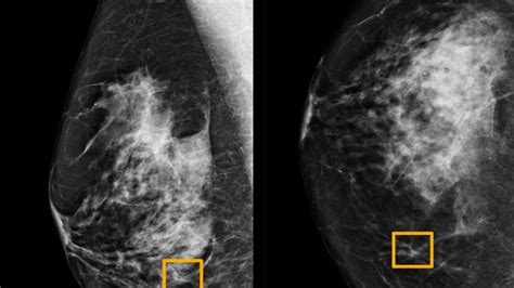 AI detects breast cancer as accurately as expert radiologists, study ...