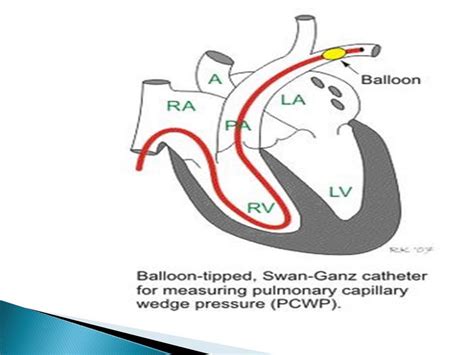 Pulmonary wedge pressure; Pulmonary Artery Wedge Pressure; Pulmonary Capillary Wedge Pressure ...