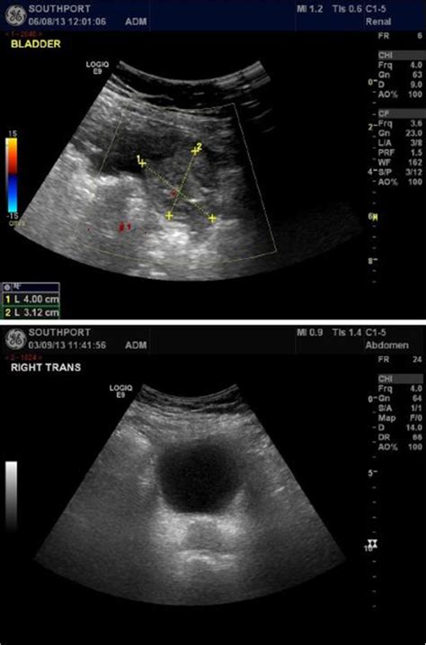 Neurogenic Bladder Ultrasound