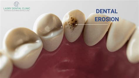 We Need To Talk About Dental Erosion: Here’s What You Need To Know