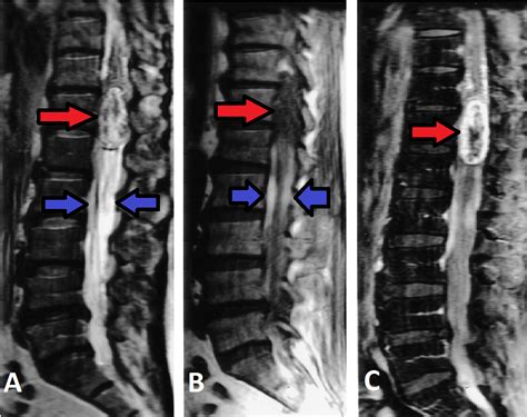 Cureus | Spinal Schwannoma with Intradural Intramedullary Hemorrhage