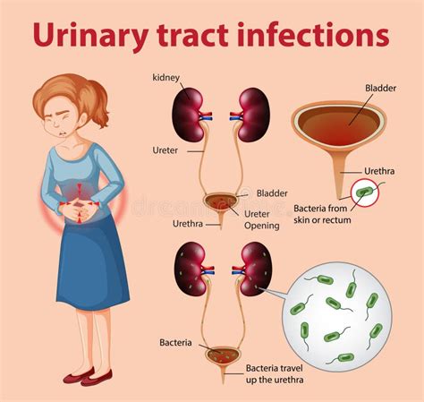 Urinary Tract Infections Stock Illustrations – 474 Urinary Tract ...