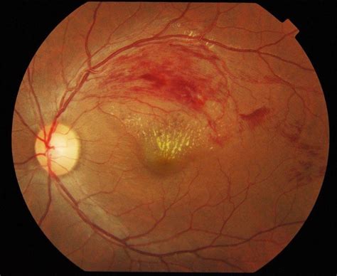 Retinal Vein Occlusion - North Wales Eye Specialist