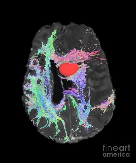 Brain Tumour, Dti Mri Scan Photograph by Sherbrooke Connectivity ...