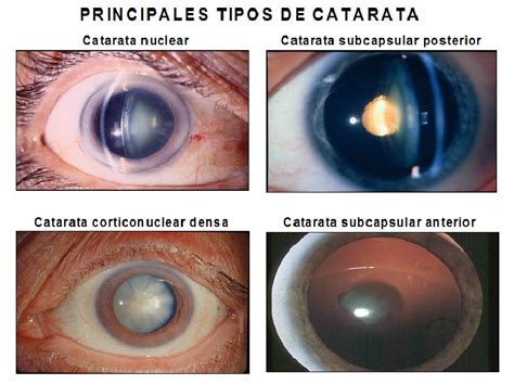 UNA FORMACIÓN DESCONOCIDA: LA CODIFICACIÓN CLÍNICA: CATARATAS