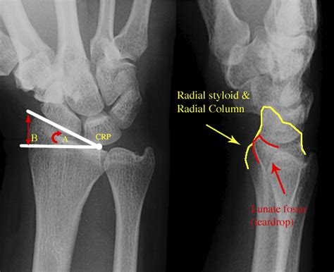 Radial Styloid Fractures - Journal of Hand Surgery